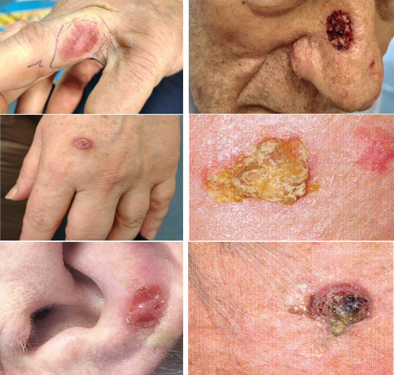 Kolaž medicinskih fotografija skvamocelularnog karcinoma (SCC) kože koji prikazuje različite kliničke oblike, uključujući ljuskave promene, ulceracije, kraste i tumorske lezije na licu, šaci i uhu.